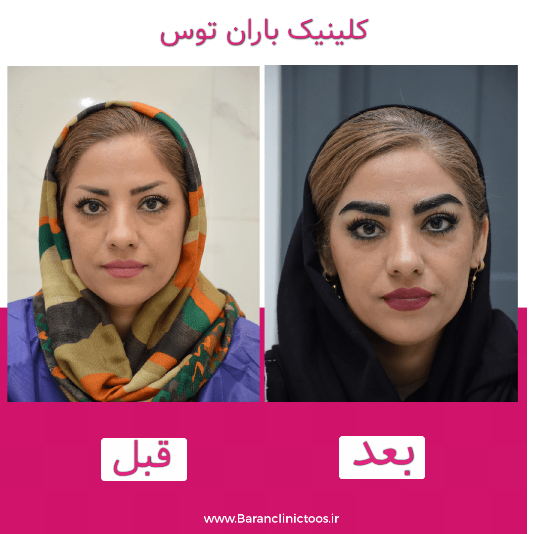 قبل و بعد کاشت ابرو